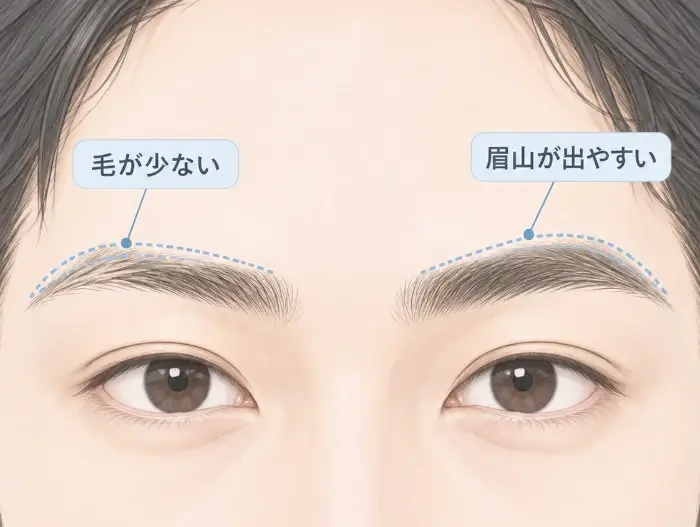 左右の眉で毛量や眉山の出方が異なる例を、目元の正面イラストと補助線で示した図。片側は毛が少なく、もう片側は眉山が出やすいなど、同じ人の眉でも左右で生え方や形の特徴が異なることを視覚化している。